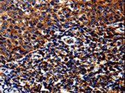 The image on the left is immunohistochemistry of paraffin-embedded Human tosil tissue using CSB-PA058807(IL13RA1 Antibody) at dilution 1/50, on the right is treated with fusion protein. (Original magnification: ×200)