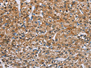 The image on the left is immunohistochemistry of paraffin-embedded Human prostate cancer tissue using CSB-PA058956(PSCA Antibody) at dilution 1/40, on the right is treated with synthetic peptide. (Original magnification: ×200)