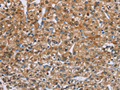 The image on the left is immunohistochemistry of paraffin-embedded Human prostate cancer tissue using CSB-PA058956(PSCA Antibody) at dilution 1/40, on the right is treated with synthetic peptide. (Original magnification: ×200)