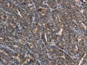 The image on the left is immunohistochemistry of paraffin-embedded Human ovarian cancer tissue using CSB-PA059543(FGF20 Antibody) at dilution 1/20, on the right is treated with synthetic peptide. (Original magnification: ×200)