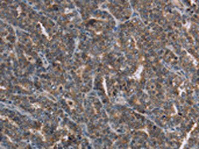 The image on the left is immunohistochemistry of paraffin-embedded Human ovarian cancer tissue using CSB-PA059543(FGF20 Antibody) at dilution 1/20, on the right is treated with synthetic peptide. (Original magnification: ×200)