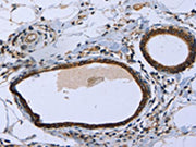 The image on the left is immunohistochemistry of paraffin-embedded Human breast cancer tissue using CSB-PA059696(MAPRE3 Antibody) at dilution 1/20, on the right is treated with fusion protein. (Original magnification: ×200)