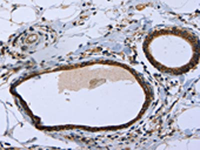 The image on the left is immunohistochemistry of paraffin-embedded Human breast cancer tissue using CSB-PA059696(MAPRE3 Antibody) at dilution 1/20, on the right is treated with fusion protein. (Original magnification: ×200)