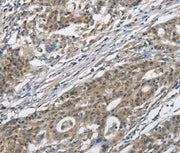 Immunohistochemical analysis of paraffin-embedded Human gastric cancer tissue using at dilution 1/30.