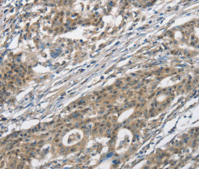 Immunohistochemical analysis of paraffin-embedded Human gastric cancer tissue using at dilution 1/30.