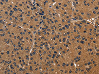 The image on the left is immunohistochemistry of paraffin-embedded Human liver cancer tissue using CSB-PA059743(ICAM4 Antibody) at dilution 1/50, on the right is treated with fusion protein. (Original magnification: ×200)