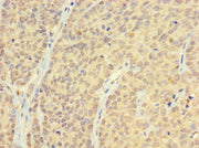 Immunohistochemistry of paraffin-embedded human ovarian cancer using CSB-PA05979A0Rb at dilution of 1:100
