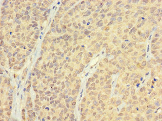 Immunohistochemistry of paraffin-embedded human ovarian cancer using CSB-PA05979A0Rb at dilution of 1:100
