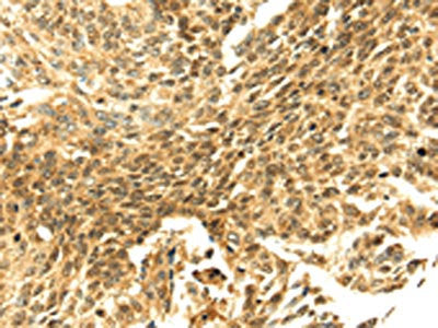 The image on the left is immunohistochemistry of paraffin-embedded Human lung cancer tissue using CSB-PA059933(SHPRH Antibody) at dilution 1/40, on the right is treated with fusion protein. (Original magnification: ×200)