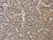 The image on the left is immunohistochemistry of paraffin-embedded Human liver cancer tissue using CSB-PA059973(DPYSL3 Antibody) at dilution 1/30, on the right is treated with fusion protein. (Original magnification: ×200)