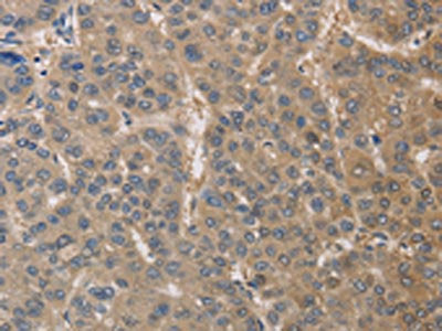 The image on the left is immunohistochemistry of paraffin-embedded Human liver cancer tissue using CSB-PA059973(DPYSL3 Antibody) at dilution 1/30, on the right is treated with fusion protein. (Original magnification: ×200)