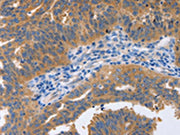 The image on the left is immunohistochemistry of paraffin-embedded Human ovarian cancer tissue using CSB-PA059985(NBEA Antibody) at dilution 1/60, on the right is treated with synthetic peptide. (Original magnification: ×200)