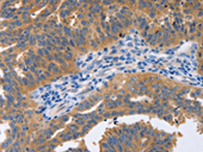 The image on the left is immunohistochemistry of paraffin-embedded Human ovarian cancer tissue using CSB-PA059985(NBEA Antibody) at dilution 1/60, on the right is treated with synthetic peptide. (Original magnification: ×200)