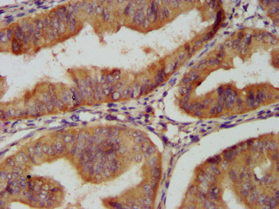 IHC image of CSB-PA06029A0Rb diluted at 1:200 and staining in paraffin-embedded human endometrial cancer performed on a Leica BondTM system. After dewaxing and hydration, antigen retrieval was mediated by high pressure in a citrate buffer (pH 6.0)...