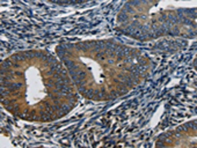 The image on the left is immunohistochemistry of paraffin-embedded Human cervical cancer tissue using CSB-PA060417(CTGF Antibody) at dilution 1/50, on the right is treated with synthetic peptide. (Original magnification: ×200)