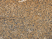 The image on the left is immunohistochemistry of paraffin-embedded Human liver cancer tissue using CSB-PA060587(TGFB1 Antibody) at dilution 1/20, on the right is treated with fusion protein. (Original magnification: ×200)