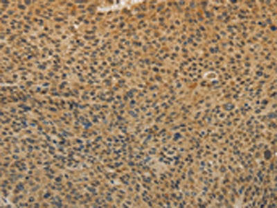 The image on the left is immunohistochemistry of paraffin-embedded Human liver cancer tissue using CSB-PA060587(TGFB1 Antibody) at dilution 1/20, on the right is treated with fusion protein. (Original magnification: ×200)