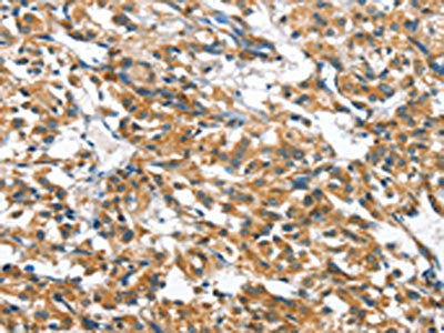 The image on the left is immunohistochemistry of paraffin-embedded Human thyroid cancer tissue using CSB-PA060691(CASQ2 Antibody) at dilution 1/30, on the right is treated with fusion protein. (Original magnification: ×200)