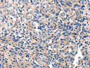 The image on the left is immunohistochemistry of paraffin-embedded Human breast cancer tissue using CSB-PA060739(GRIN2D Antibody) at dilution 1/10, on the right is treated with synthetic peptide. (Original magnification: ×200)