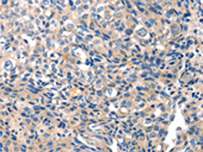 The image on the left is immunohistochemistry of paraffin-embedded Human breast cancer tissue using CSB-PA060739(GRIN2D Antibody) at dilution 1/10, on the right is treated with synthetic peptide. (Original magnification: ×200)