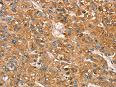The image on the left is immunohistochemistry of paraffin-embedded Human liver cancer tissue using CSB-PA060806(ART4 Antibody) at dilution 1/50, on the right is treated with synthetic peptide. (Original magnification: ×200)