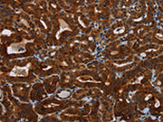 The image on the left is immunohistochemistry of paraffin-embedded Human thyroid cancer tissue using CSB-PA061054(KLHL1 Antibody) at dilution 1/30, on the right is treated with fusion protein. (Original magnification: ×200)