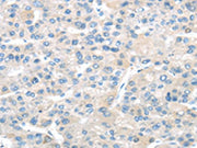 The image on the left is immunohistochemistry of paraffin-embedded Human liver cancer tissue using CSB-PA061292(TMPRSS11A Antibody) at dilution 1/20, on the right is treated with fusion protein. (Original magnification: ×200)