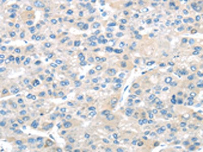 The image on the left is immunohistochemistry of paraffin-embedded Human liver cancer tissue using CSB-PA061292(TMPRSS11A Antibody) at dilution 1/20, on the right is treated with fusion protein. (Original magnification: ×200)