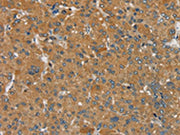 The image on the left is immunohistochemistry of paraffin-embedded Human liver cancer tissue using CSB-PA061398(SEMA6D Antibody) at dilution 1/25, on the right is treated with synthetic peptide. (Original magnification: ×200)
