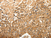 The image on the left is immunohistochemistry of paraffin-embedded Human esophagus cancer tissue using CSB-PA061492(SLC25A11 Antibody) at dilution 1/30, on the right is treated with fusion protein. (Original magnification: ×200)