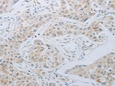 The image on the left is immunohistochemistry of paraffin-embedded Human lung cancer tissue using CSB-PA061510(LOX Antibody) at dilution 1/30, on the right is treated with synthetic peptide. (Original magnification: ×200)