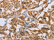 The image on the left is immunohistochemistry of paraffin-embedded Human thyroid cancer tissue using CSB-PA061766(NRN1 Antibody) at dilution 1/50, on the right is treated with fusion protein. (Original magnification: ×200)