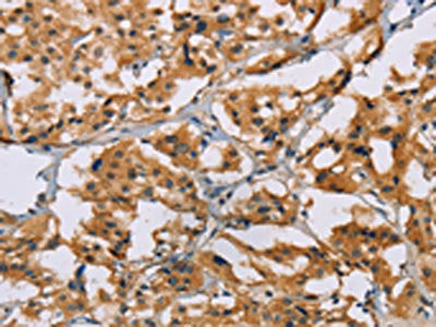 The image on the left is immunohistochemistry of paraffin-embedded Human thyroid cancer tissue using CSB-PA061766(NRN1 Antibody) at dilution 1/50, on the right is treated with fusion protein. (Original magnification: ×200)