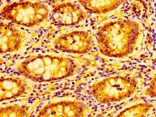 IHC image of CSB-PA06189A0Rb diluted at 1:100 and staining in paraffin-embedded human colon cancer performed on a Leica BondTM system. After dewaxing and hydration, antigen retrieval was mediated by high pressure in a citrate buffer (pH 6.0). Sect...