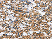 The image on the left is immunohistochemistry of paraffin-embedded Human thyroid cancer tissue using CSB-PA062002(BPI Antibody) at dilution 1/50, on the right is treated with fusion protein. (Original magnification: ×200)