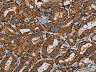 The image on the left is immunohistochemistry of paraffin-embedded Human thyroid cancer tissue using CSB-PA062043(MRPL28 Antibody) at dilution 1/45, on the right is treated with fusion protein. (Original magnification: ×200)