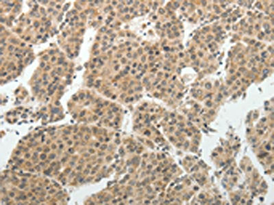 The image on the left is immunohistochemistry of paraffin-embedded Human liver cancer tissue using CSB-PA062278(SOCS7 Antibody) at dilution 1/30, on the right is treated with synthetic peptide. (Original magnification: ×200)