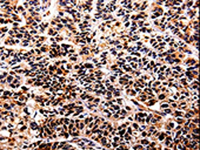 The image on the left is immunohistochemistry of paraffin-embedded Human lung cancer tissue using CSB-PA062287(IL10RA Antibody) at dilution 1/30, on the right is treated with fusion protein. (Original magnification: ×200)