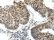 The image on the left is immunohistochemistry of paraffin-embedded Human colon cancer tissue using CSB-PA062296(TOP2A Antibody) at dilution 1/30, on the right is treated with synthetic peptide. (Original magnification: ×200)