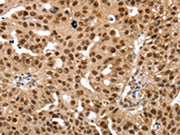 The image on the left is immunohistochemistry of paraffin-embedded Human breast cancer tissue using CSB-PA062373(SMARCB1 Antibody) at dilution 1/30, on the right is treated with fusion protein. (Original magnification: ×200)