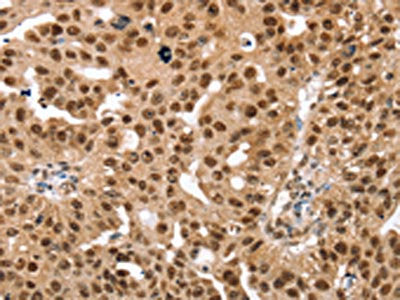 The image on the left is immunohistochemistry of paraffin-embedded Human breast cancer tissue using CSB-PA062373(SMARCB1 Antibody) at dilution 1/30, on the right is treated with fusion protein. (Original magnification: ×200)