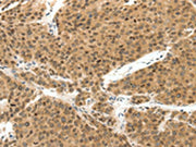 The image on the left is immunohistochemistry of paraffin-embedded Human liver cancer tissue using CSB-PA062412(TERF2 Antibody) at dilution 1/30, on the right is treated with synthetic peptide. (Original magnification: ×200)