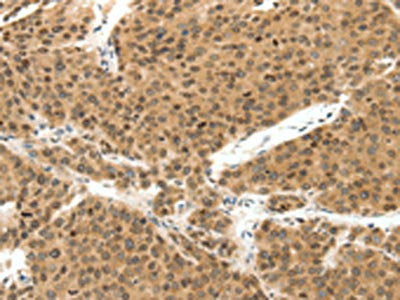 The image on the left is immunohistochemistry of paraffin-embedded Human liver cancer tissue using CSB-PA062412(TERF2 Antibody) at dilution 1/30, on the right is treated with synthetic peptide. (Original magnification: ×200)
