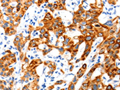 The image on the left is immunohistochemistry of paraffin-embedded Human lung cancer tissue using CSB-PA062447(SLC2A11 Antibody) at dilution 1/140, on the right is treated with synthetic peptide. (Original magnification: ×200)