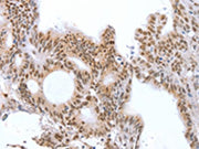 The image on the left is immunohistochemistry of paraffin-embedded Human colon cancer tissue using CSB-PA062537(CTBP2 Antibody) at dilution 1/25, on the right is treated with fusion protein. (Original magnification: ×200)