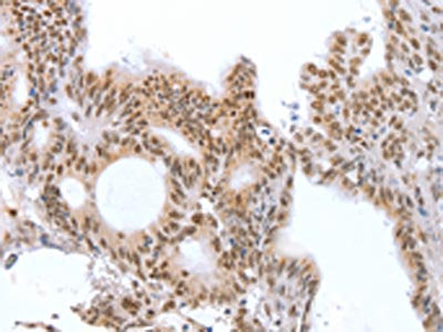The image on the left is immunohistochemistry of paraffin-embedded Human colon cancer tissue using CSB-PA062537(CTBP2 Antibody) at dilution 1/25, on the right is treated with fusion protein. (Original magnification: ×200)