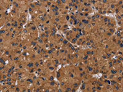 The image on the left is immunohistochemistry of paraffin-embedded Human liver cancer tissue using CSB-PA062668(NPRL2 Antibody) at dilution 1/50, on the right is treated with synthetic peptide. (Original magnification: ×200)