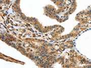 The image on the left is immunohistochemistry of paraffin-embedded Human thyroid cancer tissue using CSB-PA062674(UTS2B Antibody) at dilution 1/25, on the right is treated with synthetic peptide. (Original magnification: ×200)