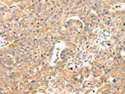 The image on the left is immunohistochemistry of paraffin-embedded Human breast cancer tissue using CSB-PA062822(S100A12 Antibody) at dilution 1/45, on the right is treated with fusion protein. (Original magnification: ×200)