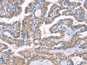 The image on the left is immunohistochemistry of paraffin-embedded Human thyroid cancer tissue using CSB-PA062845(AP1B1 Antibody) at dilution 1/70, on the right is treated with synthetic peptide. (Original magnification: ×200)